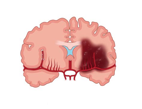 Hemorrhagic Stroke | Penumbra Inc