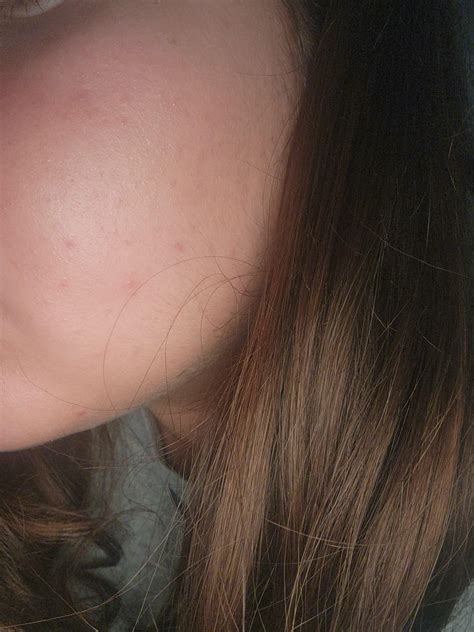 [Acne] How do i get rid of these red blotches/acne on my face? : r