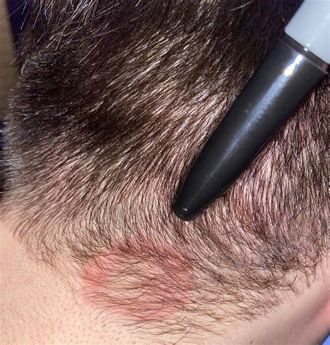 Red circle on scalp, no bumps, flakes, not itchy. Anyone know what it ...