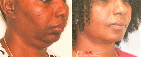 chin augmentation implant facial surgery