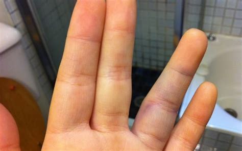 home remedies  swollen finger yabibo