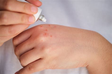 'Stop Writing Systemic Corticosteroids for Atopic Dermatitis