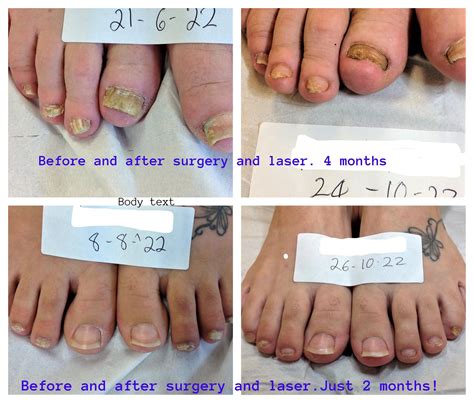 See Stages of Toenail Growing Back Pictures