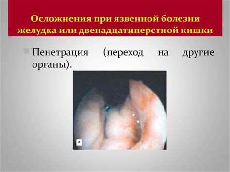 Язвенная болезнь желудка и двенадцатиперстной кишки - презентация онлайн