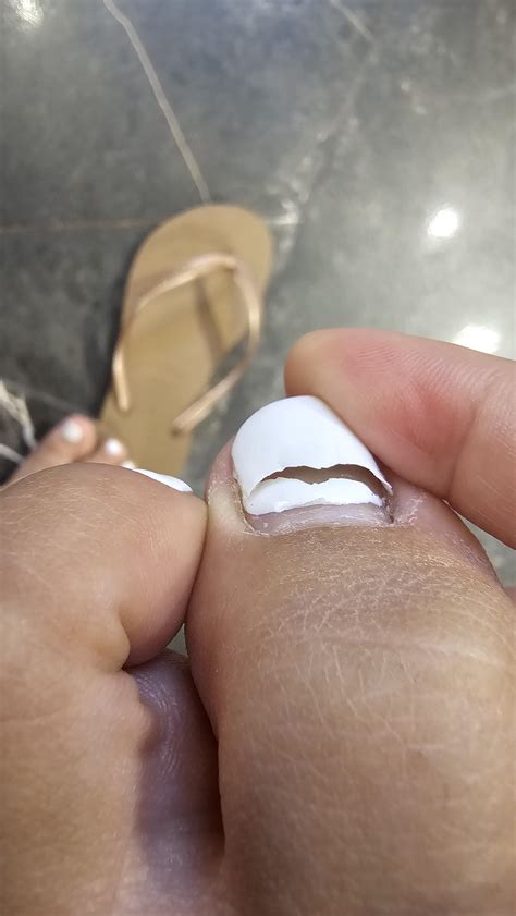 My girlfriend's toe nail completely broke near cuticle. Any advice on