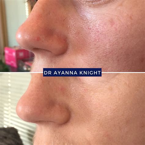 Cryotherapy Cost Warts at Melissa Lindstrom blog