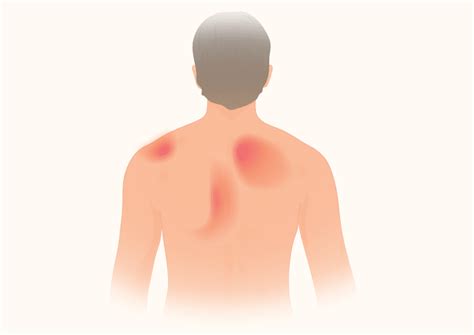 Shoulder Blade Pain Left Side How To Relieve Shoulder Blade Pain