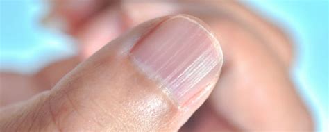 Prevenir y tratar las estrías en las uñas | Blog Druni