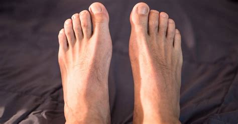 toenail fungus      mahoney dermatology