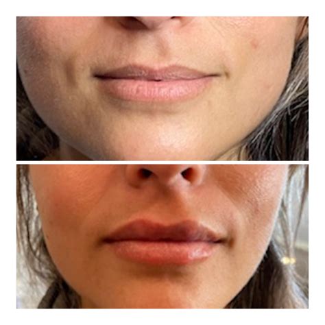 Needle Free Lip FIllerTry Needle Free Lip Fillers for Fuller Lips!
