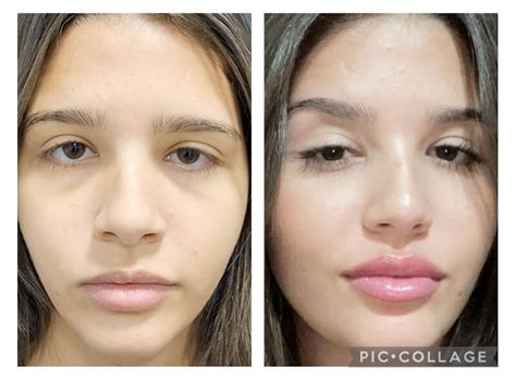 Preenchimento Olheiras Antes E Depois - Antes e Depois: Tratamento de olheiras, Preenchimento labial e ...