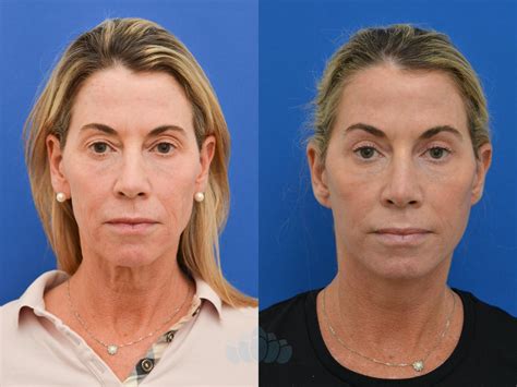 eyelid surgery    photo gallery charlotte nc