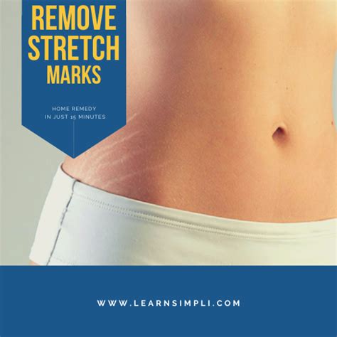 how to remove stretch marks at home