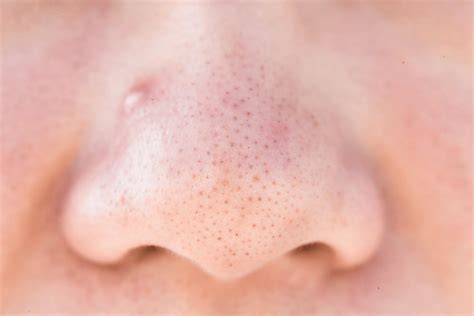 rid  black heads  nose  derma store