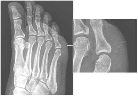 Anderson Silva Broken Leg X Ray