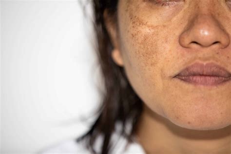 What Is Chloasma | Dr. Len Kliman