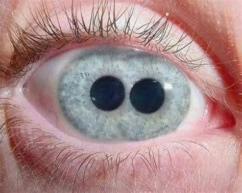 Polycoria (2 Pupils in Eye) Symptoms & Treatment