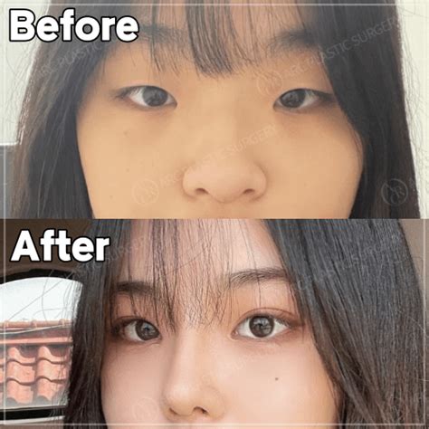 [Before/After] Double eyelid surgery & Rhinoplasty : r/cosmeticsurgery