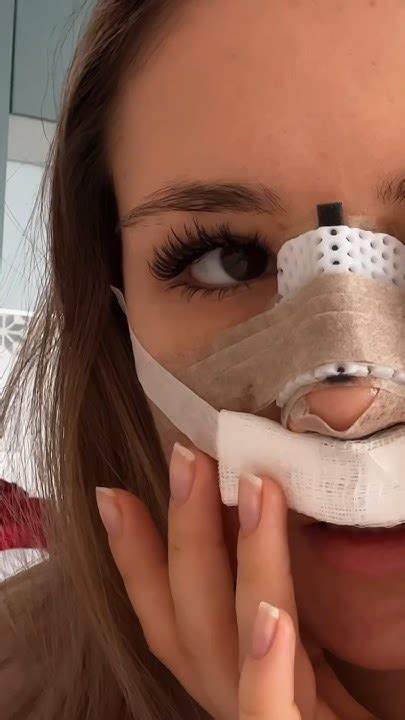 Полное видео про ринопластику на канале #ринопластика # ...