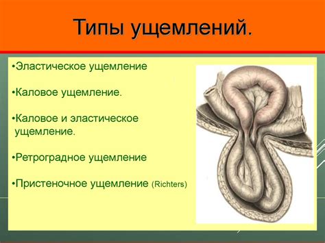 Классификация грыж. Хирургическая тактика при ущемленных грыжах живота ...