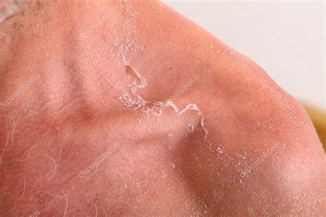 Sunburn Peeling Face
