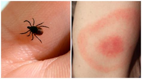 lyme disease surges  quebec       protect