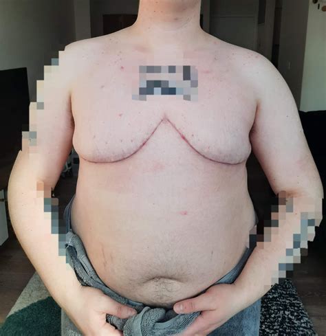 bruising at over 5 weeks post-op? : r/TopSurgery