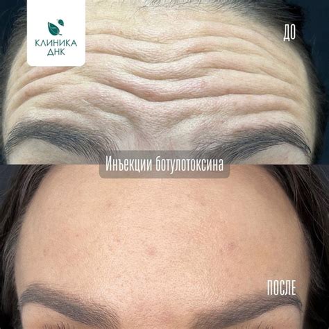 Ботулотоксин в косметологии | Характеристика ботулинотерапии, показания ...