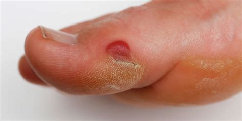 dos   nots  treating blood blisters advanced foot ankle