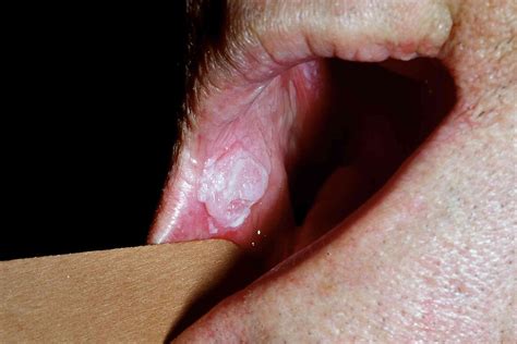 Does Throat Cancer Cause White Spots On Tonsils - Infoupdate.org
