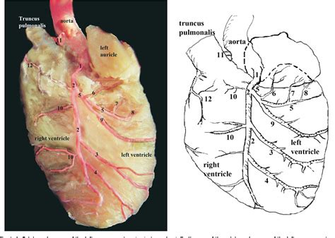 Coronary Artery Anatomy Ramus