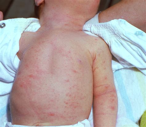 rashes on the face of a newborn 11