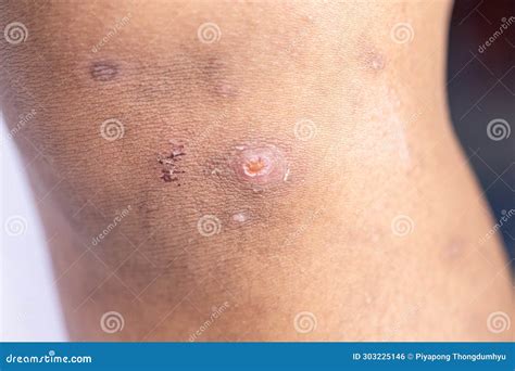 Atopic Dermatitis and Fungal Diseases on the Human Body. Stock Photo ...