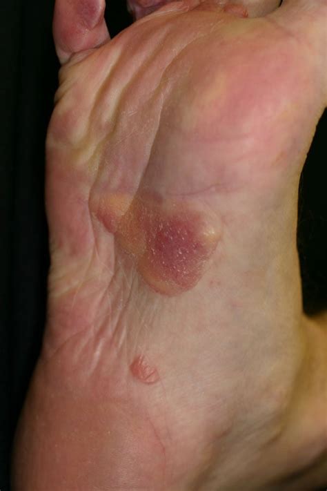 Amyloidosis Skin Changes