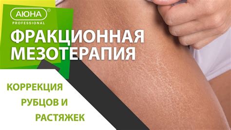 Фракционная мезотерапия, коррекция рубцов и растяжек, техника процедуры ...