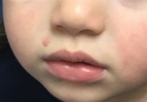 molluscum contagiosum  lip   molluscum contagiosum