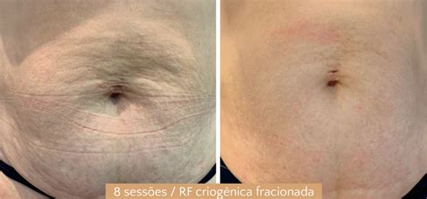 Radiofrequência Íntima Antes E Depois - Radiofrequência criogênica: como ter mais resultado? | Adoxy