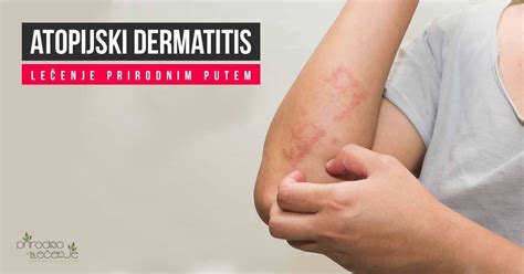Atopijski Dermatitis - Lečenje Prirodnim Putem | Prirodno Lečenje