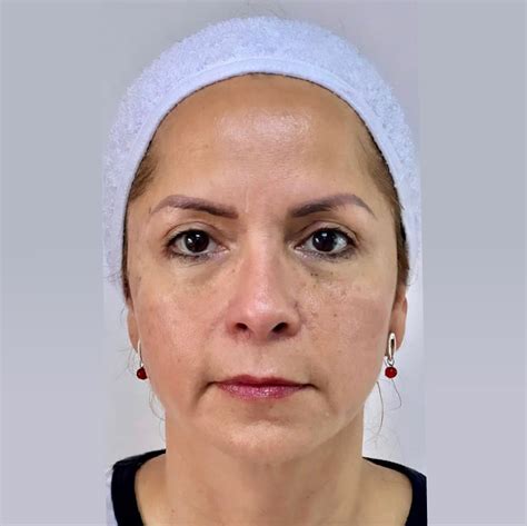 Cirujano Maxilo Facial Estético - Doctor Rostro Diamante