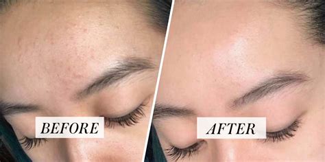 redditor shares transformative fungal acne routine