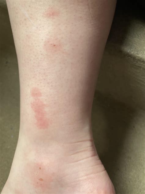 Need help identifying what is biting me when I’m at my boyfriends house