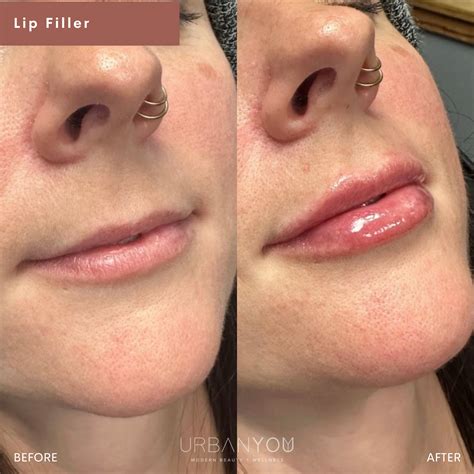 How to Reverse Sagging Skin from Ozempic Face and Mounjaro Face — Urban