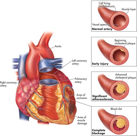 Atherosclerosis Disease Symptoms Natural Remedies ~ Medicinal Words