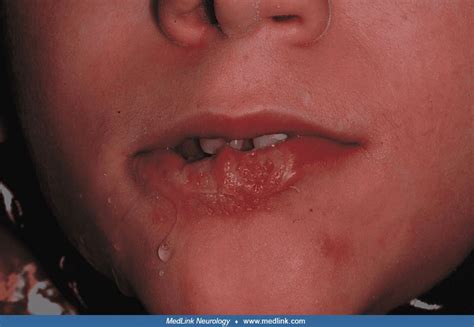 Ulcerative lesion in Lesch-Nyhan disease (mouth closed) | MedLink Neurology