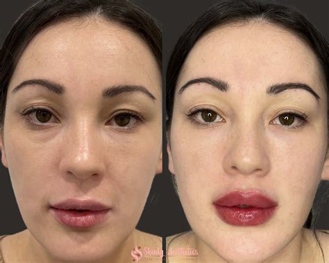 Lip Filler Before And After Healed at Santos Long blog