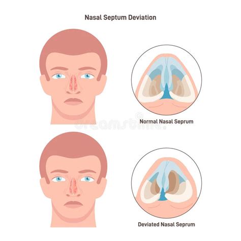 Deviated and Normal Nasal Septum. Medical Condition of Crooked Stock ...