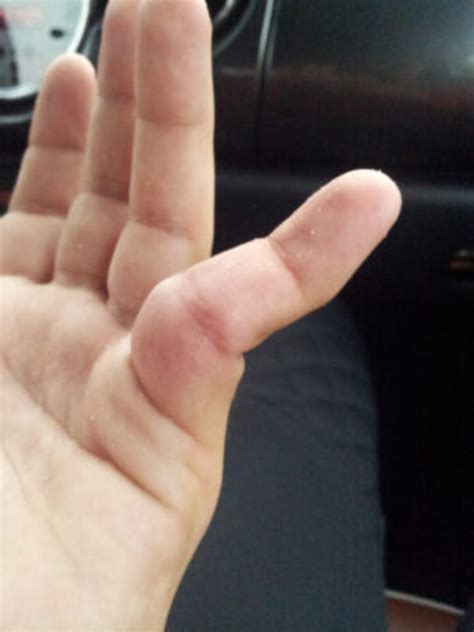A Dislocated Thumb at Mark Bateman blog