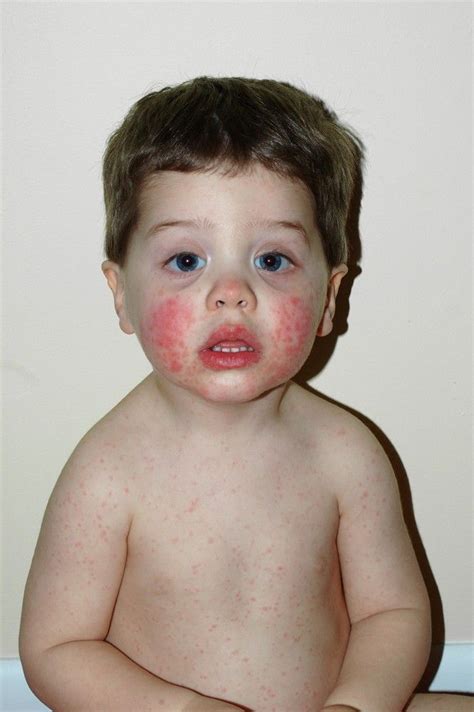 Image:Rash Caused by Erythema Infectiosum-Merck Manual Consumer Version