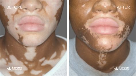 Skin Pigmentation Treatment | Melasma & Vitiligo | Tareen - Tareen