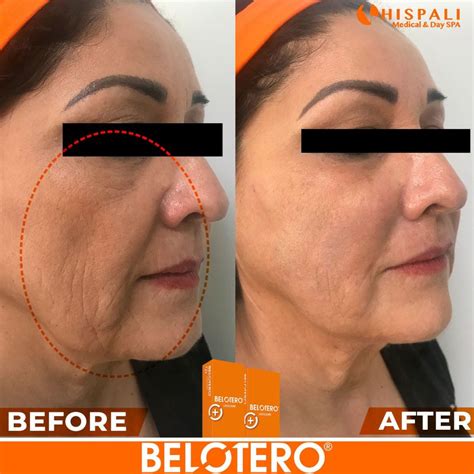 Belotero Results - Dr. Baja